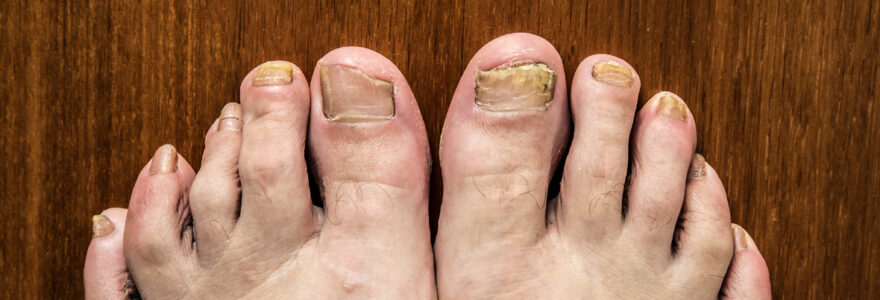 Fungal Nail Infections